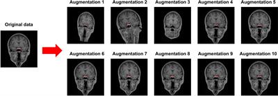 deepPGSegNet: MRI-based pituitary gland segmentation using deep learning